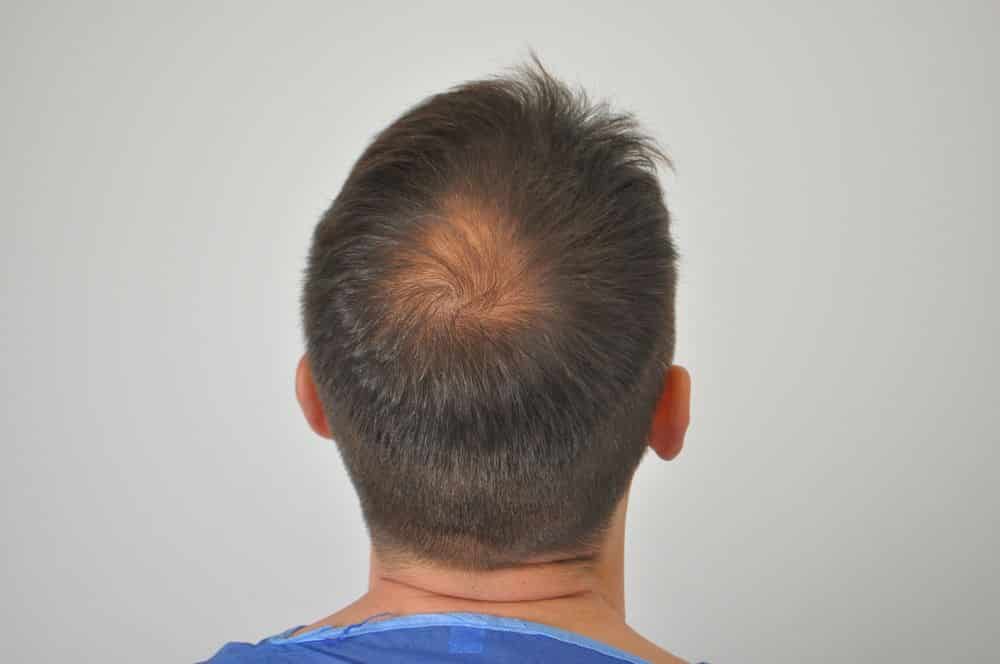 Alopecia Androgénica