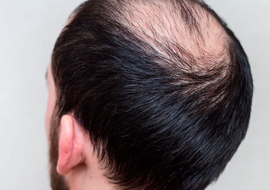 alopecia androgenética masculina
