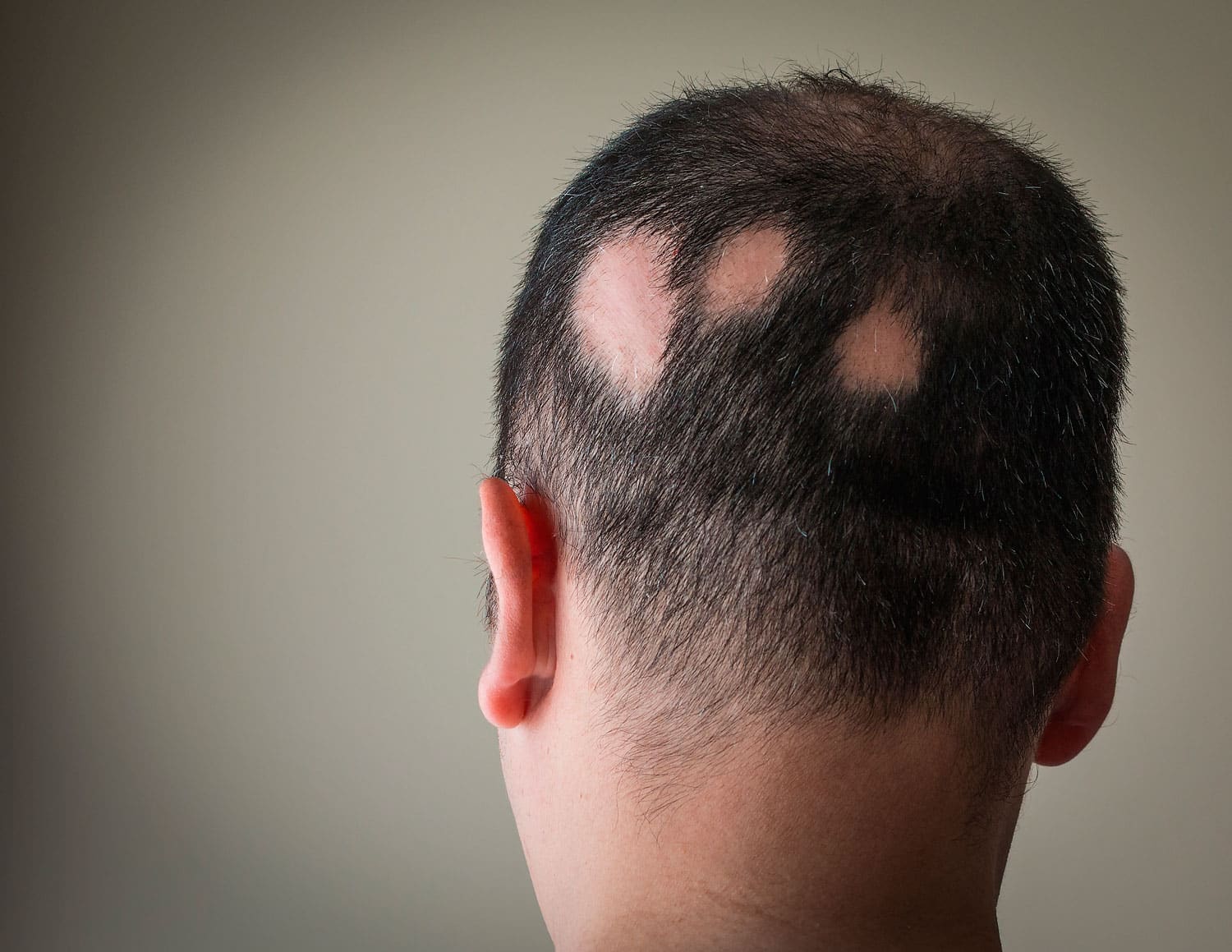 Alopecia Areata