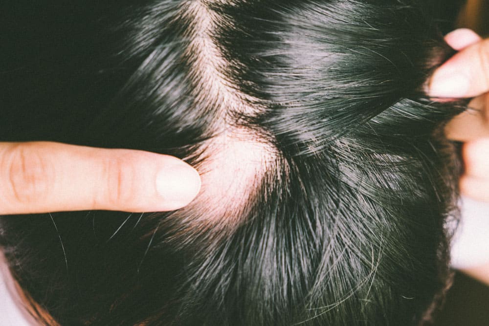 Alopecia Areata Tratamiento