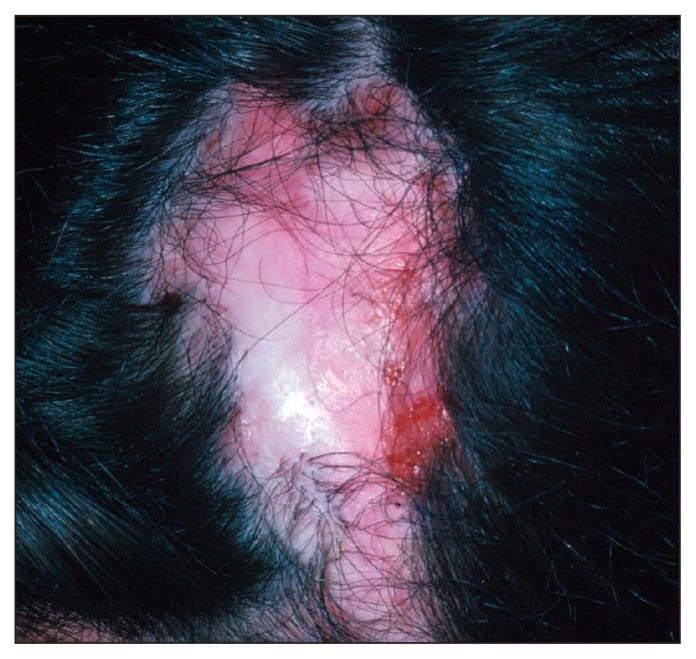 alopecia cicatrizal