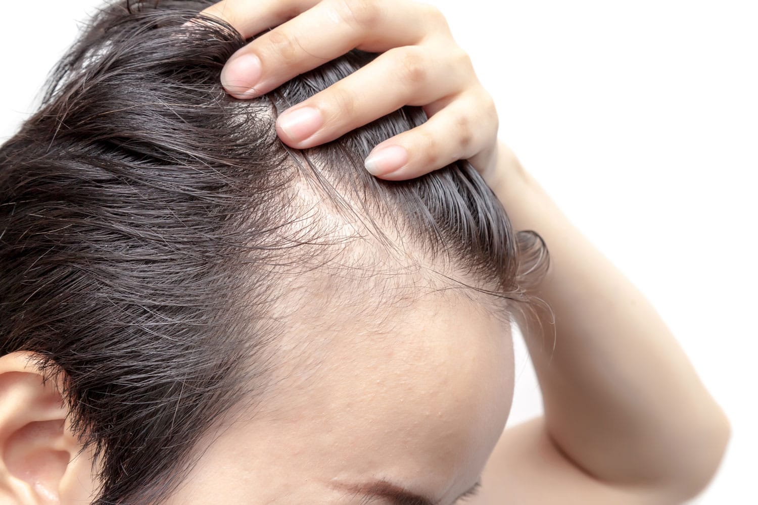 Alopecia Difusa Femenina