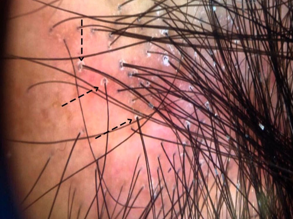 alopecia fibrosante