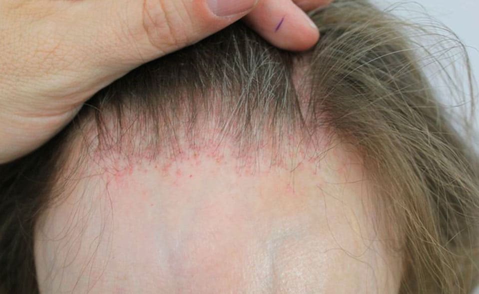 alopecia frontal fibrosante