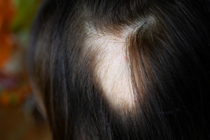alopecia nerviosa