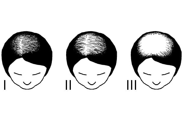 Escala Ludwig Alopecia femenina