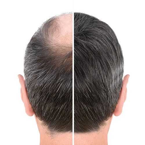 alopecia androgénica resultados