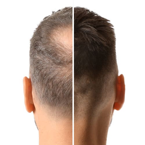 resultados tratamientos alopecia