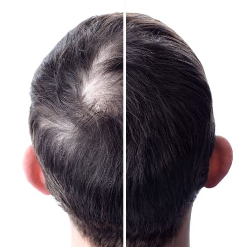 alopecia androgénica resultados