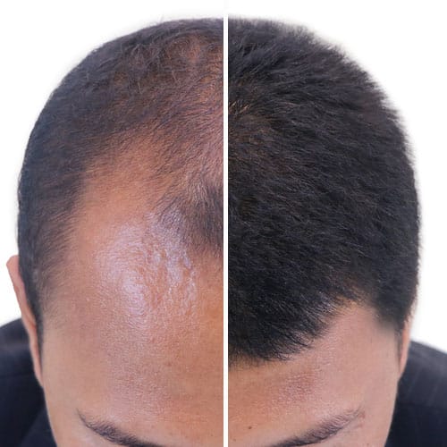 resultados tratamientos alopecia