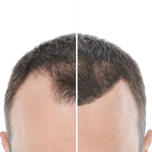 alopecia difusa resultados