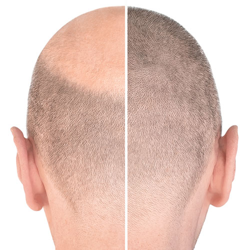 alopecia difusa resultados