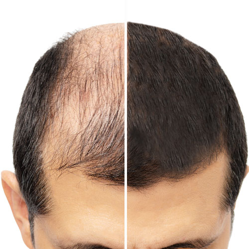alopecia androgénica resultados