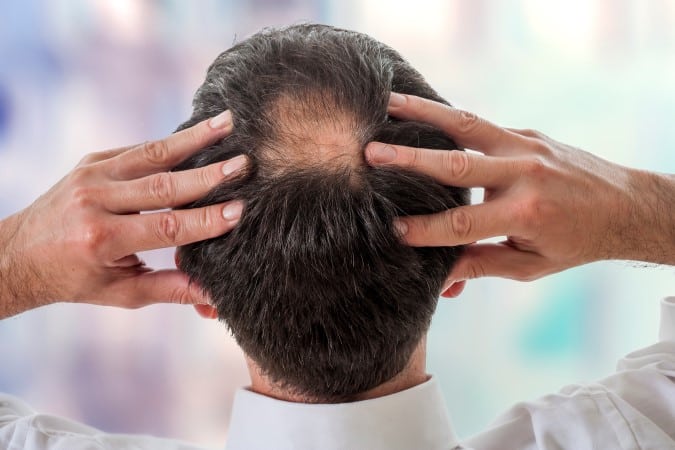 Cómo la Alopecia en la Coronilla? - Clínica Tratamiento Capilar