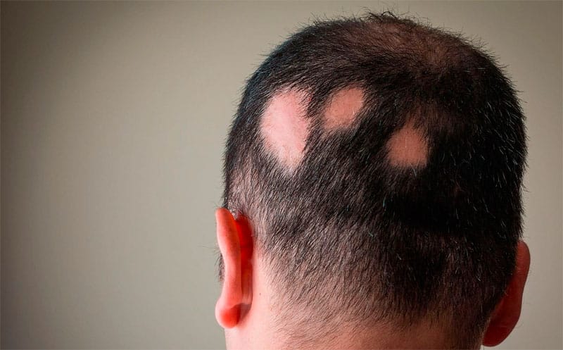 Alopecia Areata