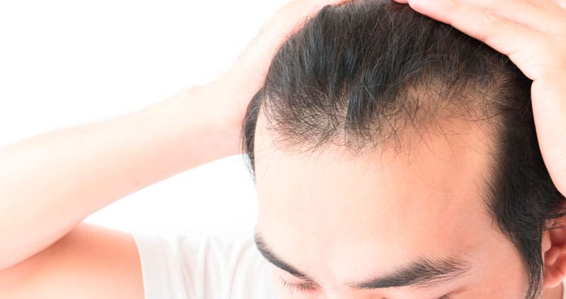 Alopecia cicatrizante