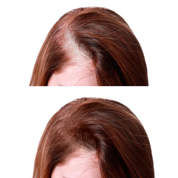 Tratamiento y resultados alopecia difusa