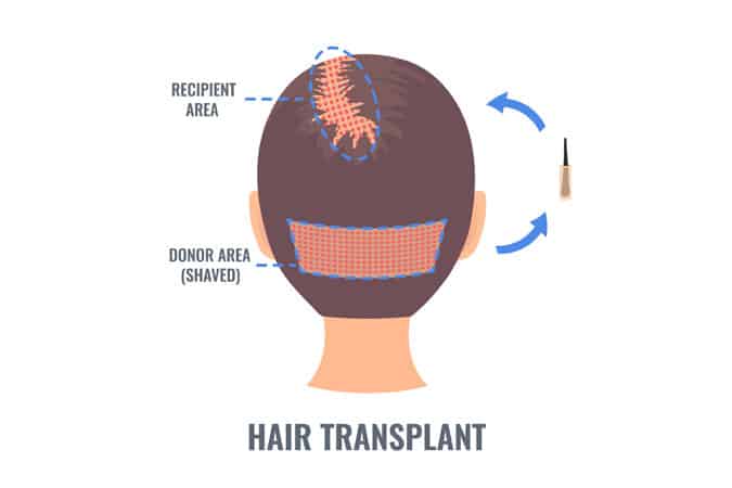 zona donante transplante capilar